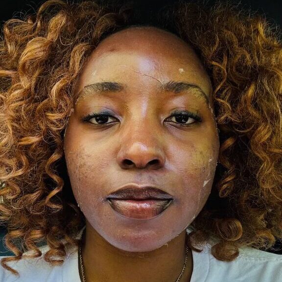 Chemical Peels 5 3-4 Days After