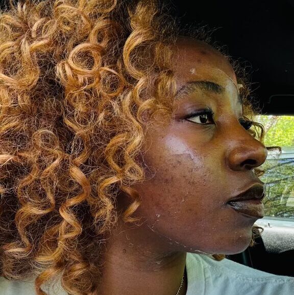Chemical Peels 6 3-4 Days After