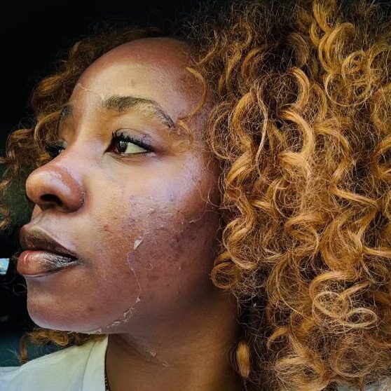 Chemical Peels 4 3-4 Days After