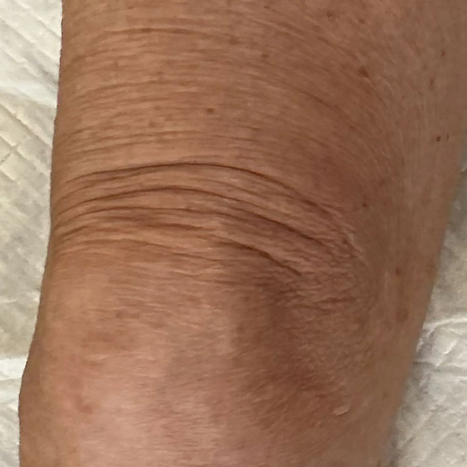Before XERF (Upper Knee)