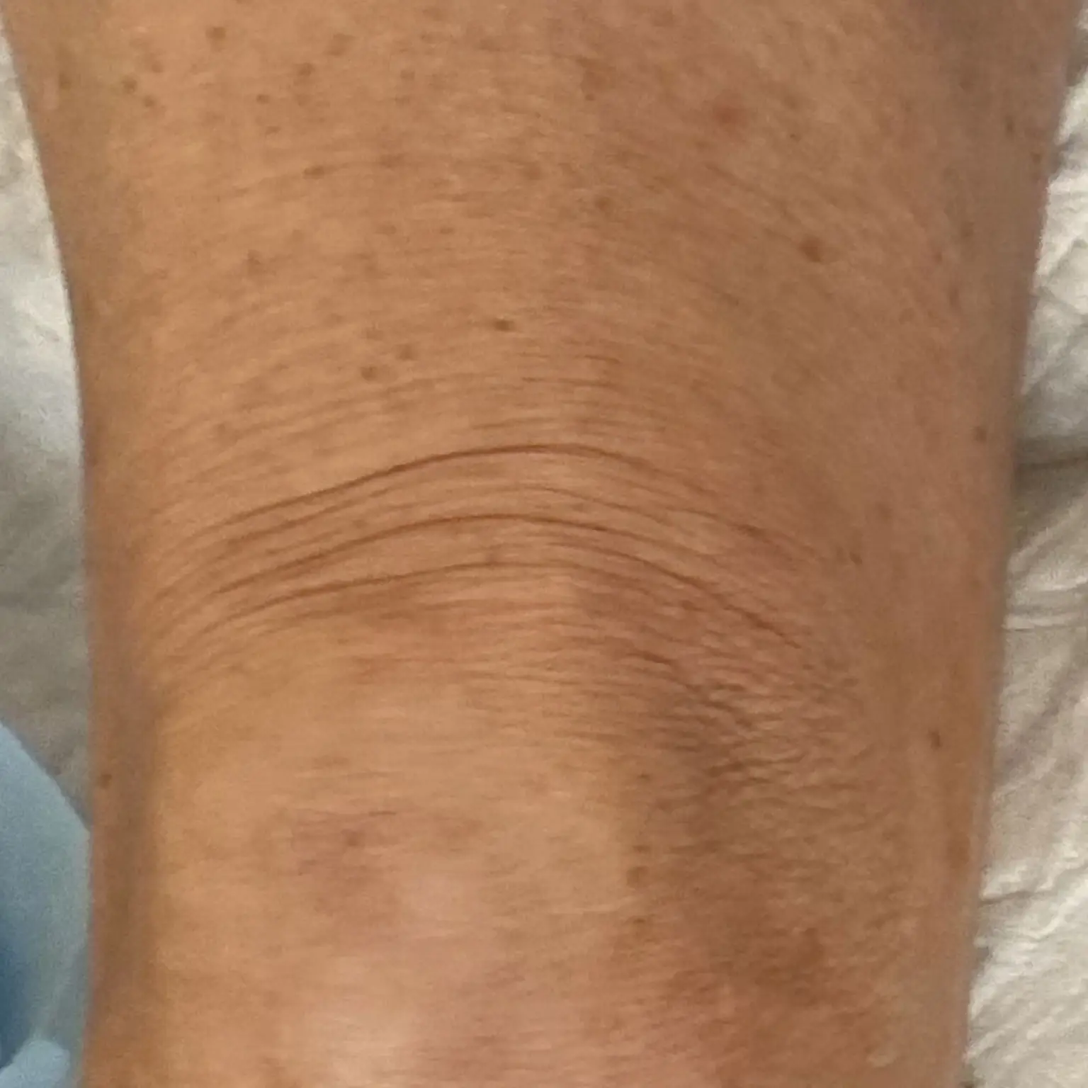 4 Weeks After XERF (Upper Knee)