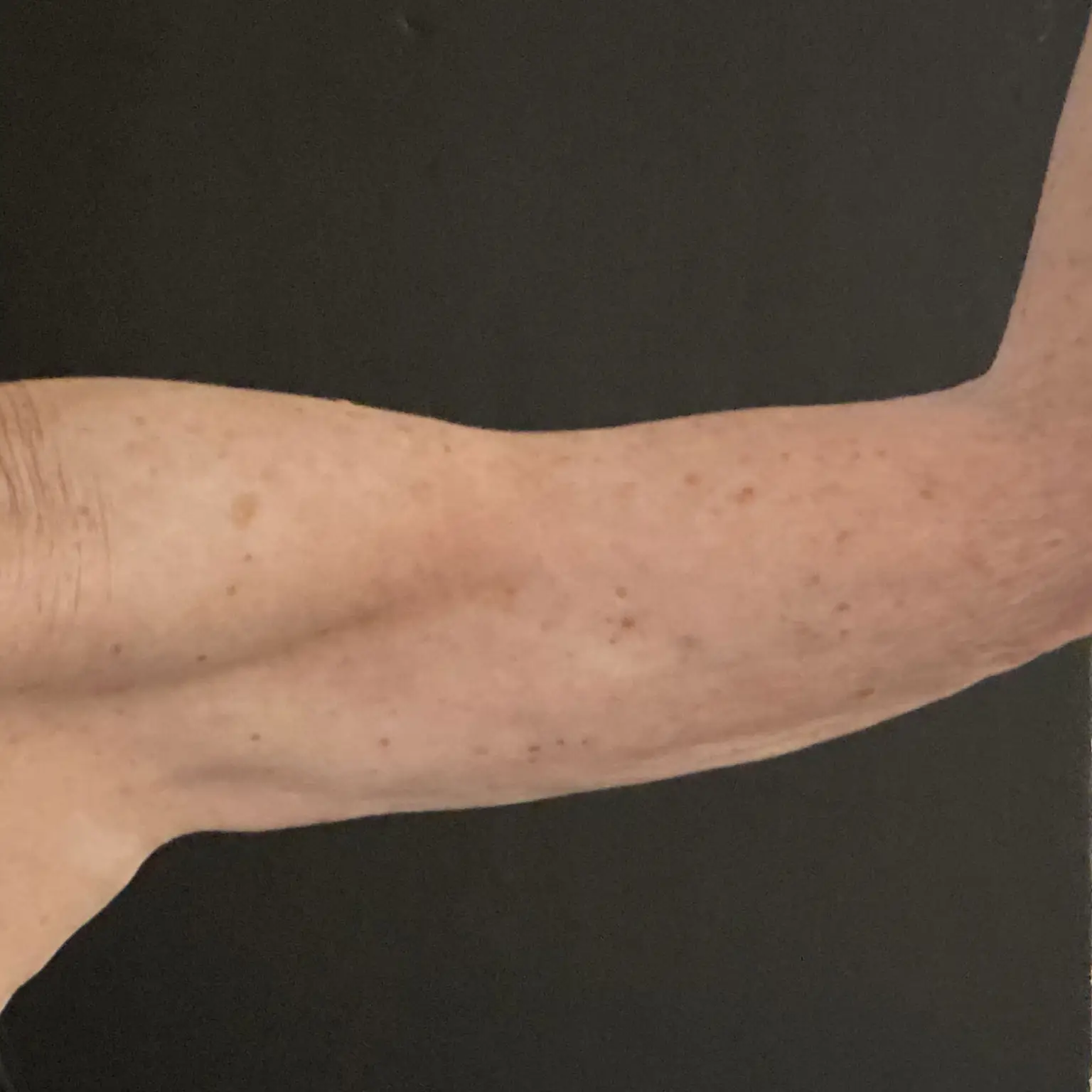 4 Weeks After XERF